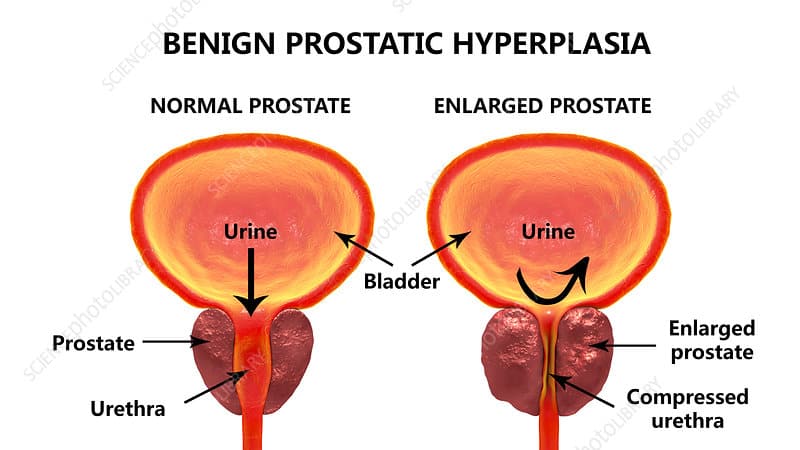Acupressure may help relieve symptoms of benign prostatic hyperplasia.