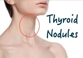 Acupressure for thyroid nodules