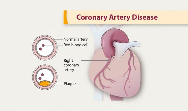 acupressure for coronary artery disease