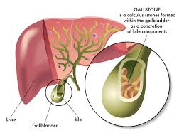acupressure for gallstones