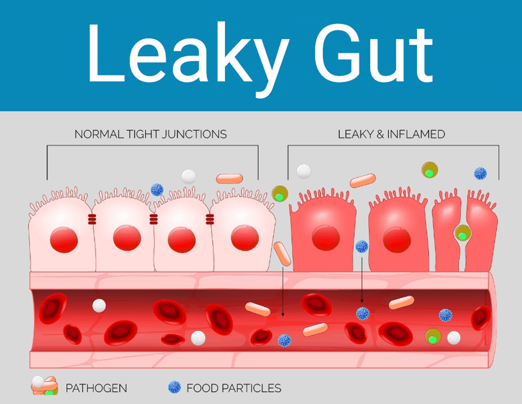 acupressure for leaky gut symptoms