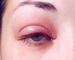 Acupressure for swollen eyelids