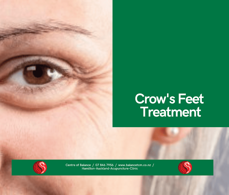Crow's Feet Treatment|Crow's Feet Treatment|Crow's Feet Treatment