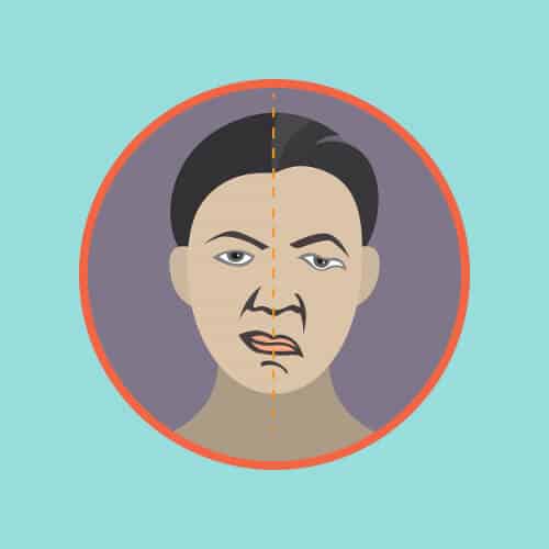 Treating Bell's Palsy with Acupuncture