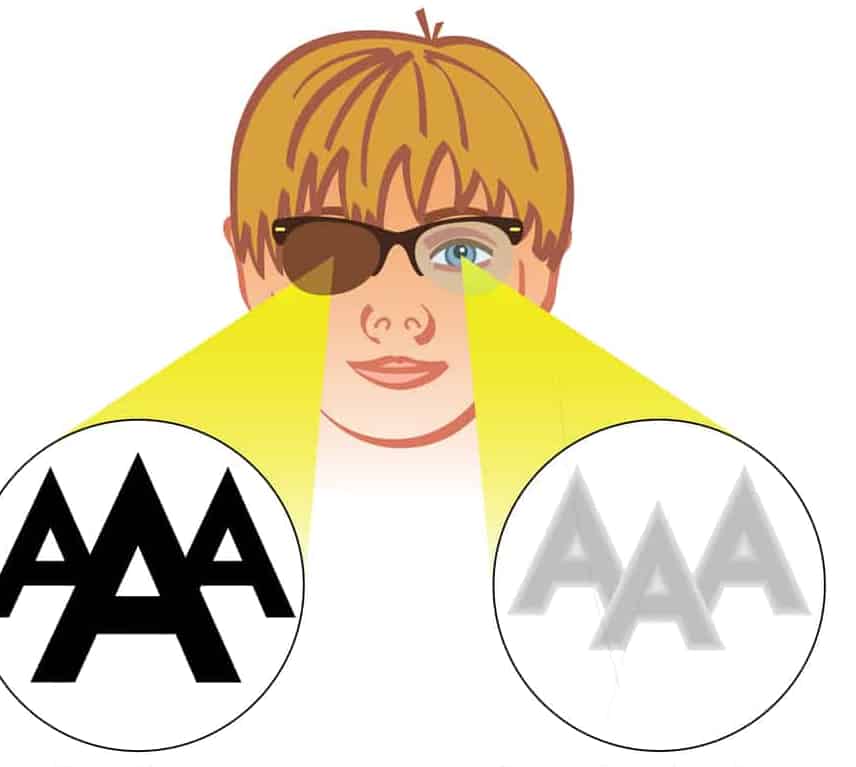 Acupuncture for Lazy Eye|