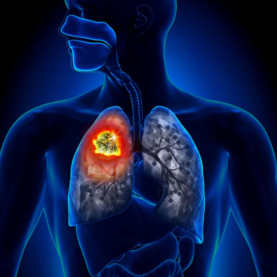 Lung Cancer Causes