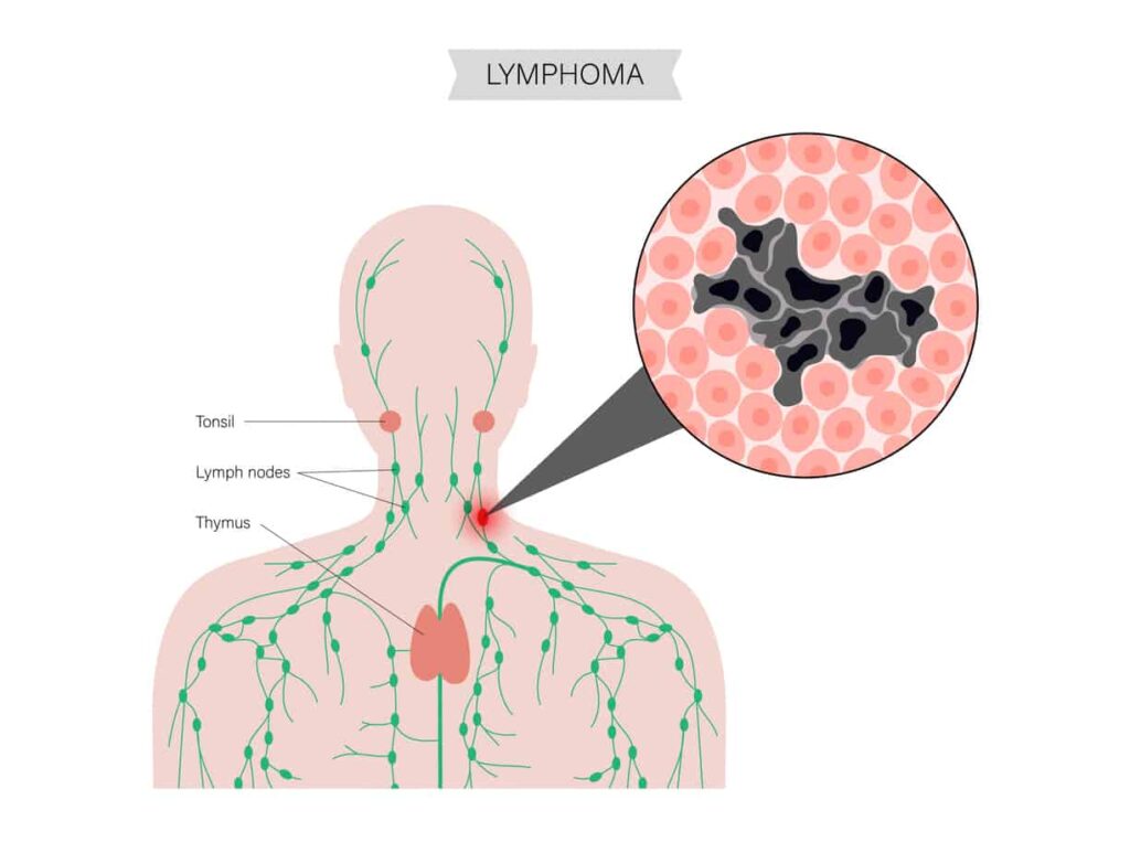 Non-Hodgkin's Lymphoma Treatment