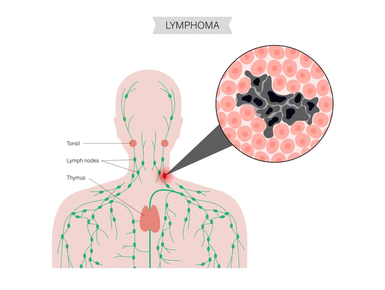 Non-Hodgkin's Lymphoma Treatment