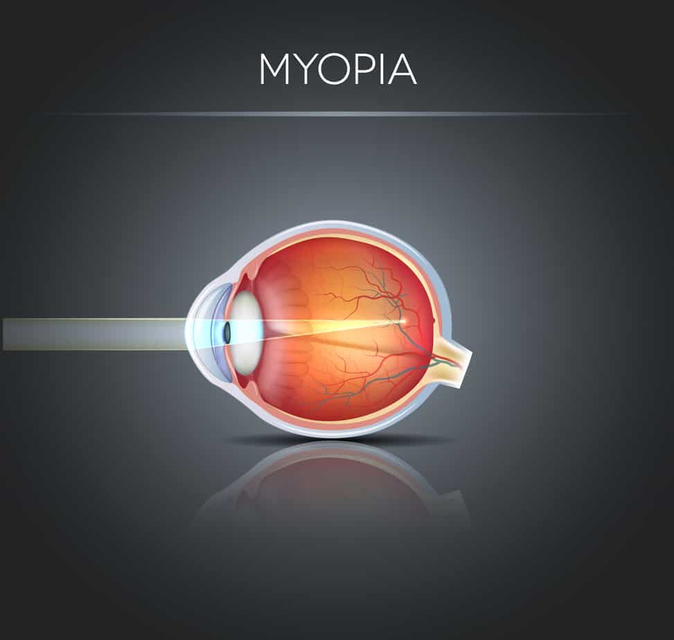 Nearsightedness Treatment