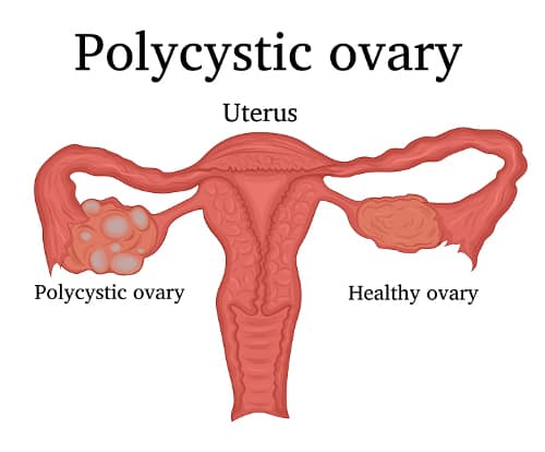 Lifestyle for PCOS