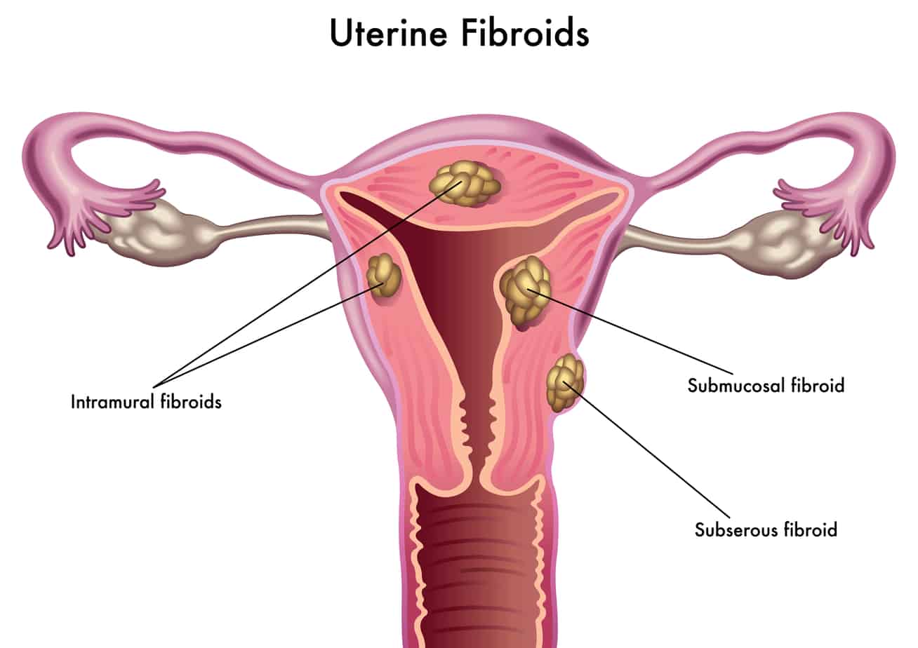 Uterine Fibroids