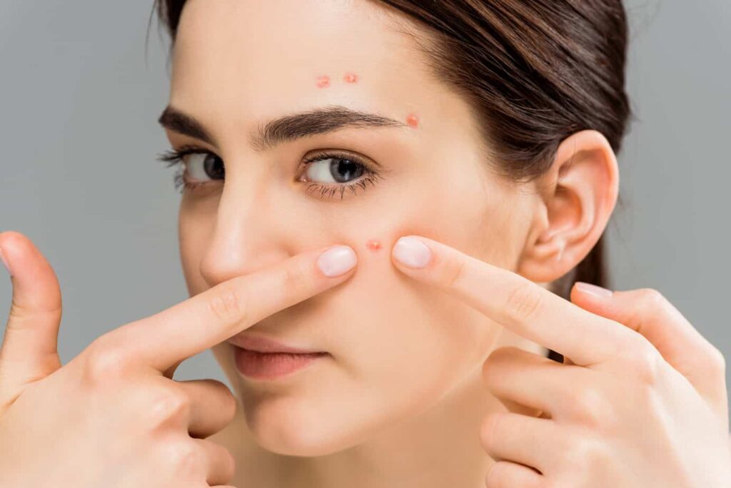chinese medicine for acne