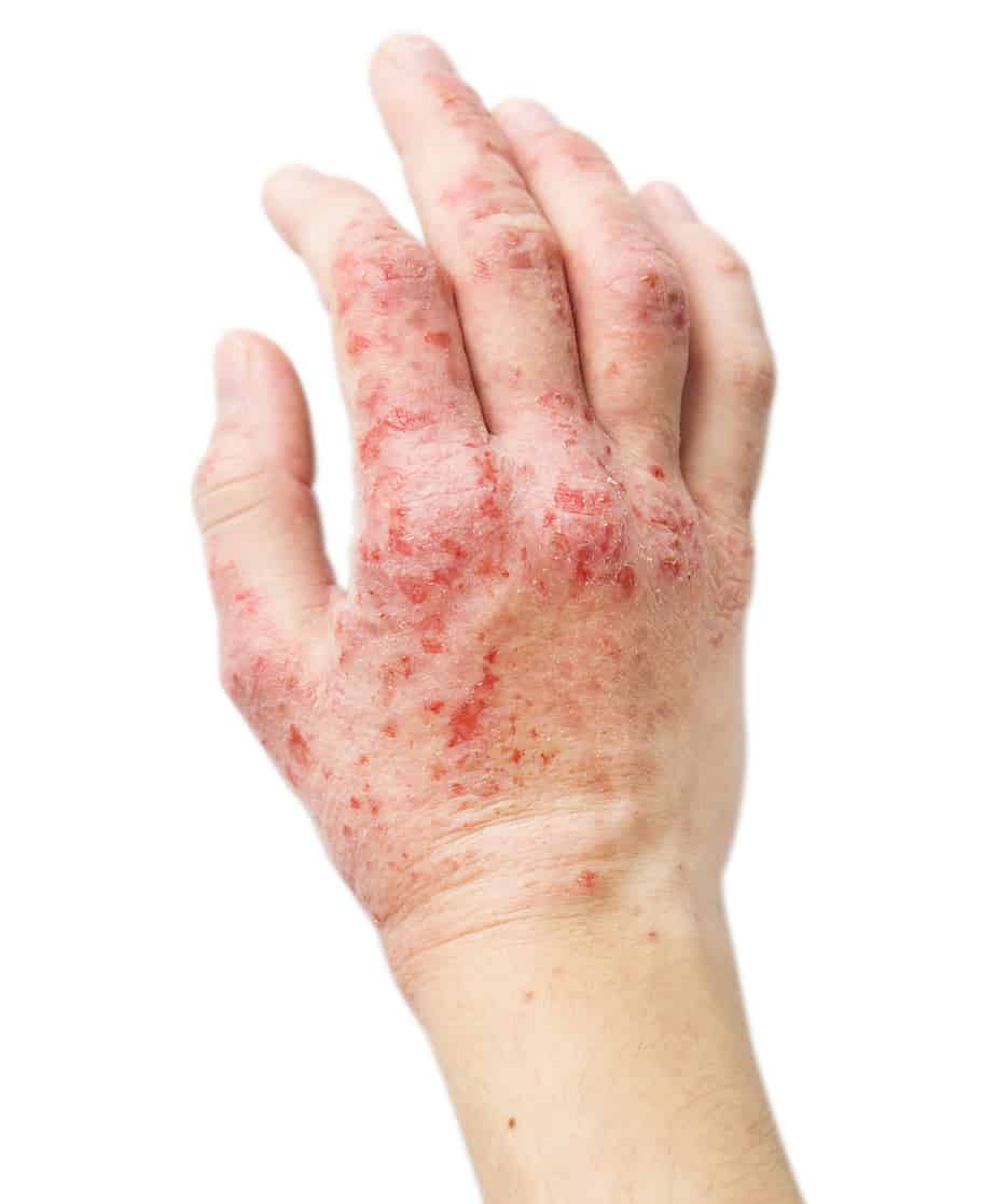 Eczema Causes