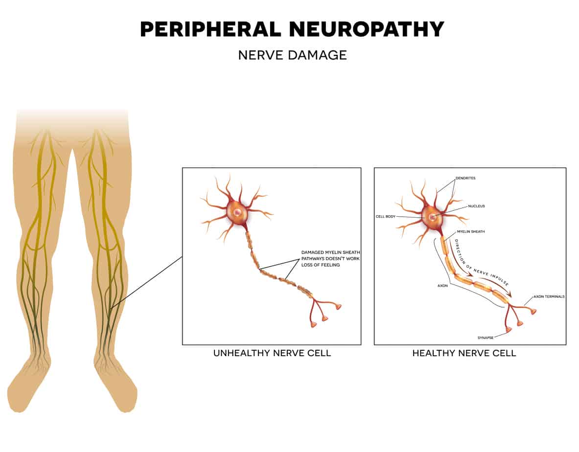 Natural Treatments for Peripheral Neuropathy|
